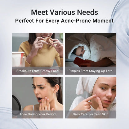 ⭐⭐⭐⭐⭐Overnight Acne Drying Lotion – Fast Spot Treatment for Pimples & Breakouts